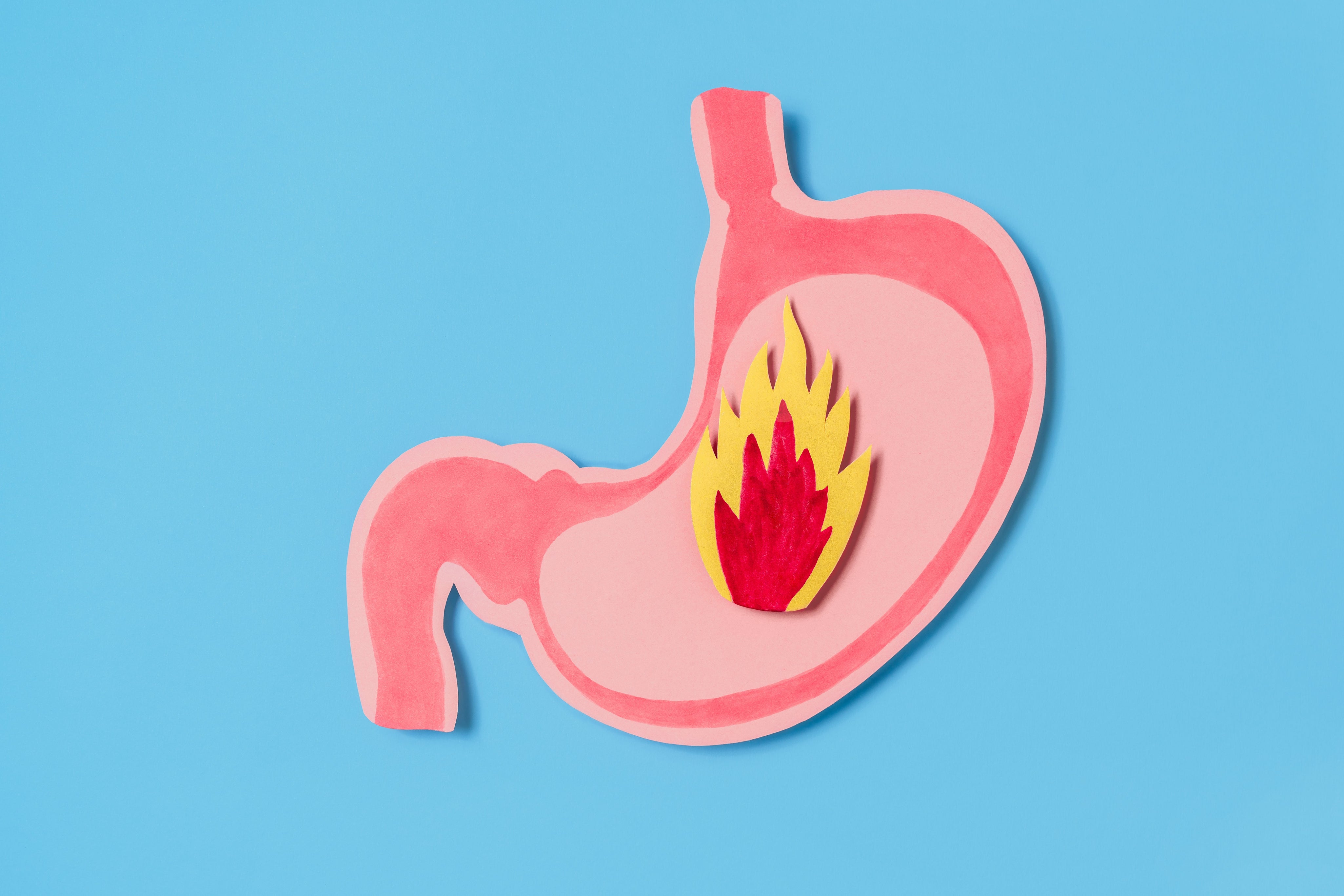 How Inclined Bed Therapy Can Help Reduce Acid Reflux and Heartburn
